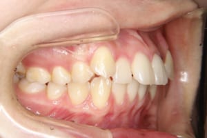 上の犬歯が八重歯、前歯が突出しています。